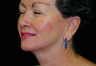 Facelift