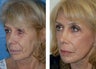 Mini-Facelift, CO2 Laser