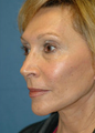 Mini Lift Surgery and Injectable Fillers