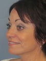 Lite Lift, Brow Lift