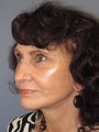 Lite Lift™, Eyelid Lift