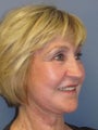 Lite Lift™, Eyelid lift, brow lift, Liposuction to chin