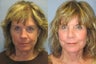 Lite Lift, Brow Lift, Neck Lift, Eyelid Lift, Blue Peel