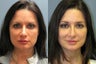 Lite Lift, Brow Lift