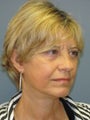 Lite Lift, brow lift, upper eyelid lift