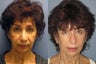 Lite Lift, Brow Lift