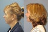 Lite Lift, Chin augmentation, liposuction of the neck