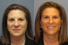Lite Lift, brow lift, blue peel, eyelid lift
