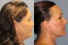 Lite Lift, Liposuction of the  neck