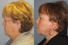 Lite Lift, liposuction of the neck, eyelid lift, brow lift