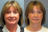 Lite Lift, liposuction of the neck