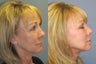 Lite Lift, Liposuction of the neck, blue peel, brow lift