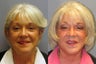 Lite Lift, Liposuction of the neck, Brow Lift, Blue Peel