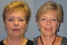 Lite Lift™, liposuction of the neck, lower eyelid lift
