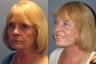 Lite Lift™, liposuction of the neck