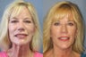 Lite Lift™, neck lift