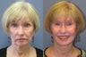 Lite Lift™, liposuction of the neck