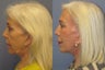 Lite Lift™, brow lift