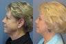 Lite Lift™, brow lift, liposuction of the nec, neck lift, blue peel