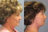 Lite Lift™, neck lift, liposuction of the neck