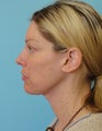 Facelift