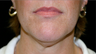 neck liposuction
