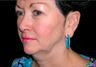 Facelift