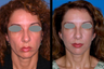 Mid-face (cheek) lift and mini-facelift