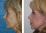 Mini-Facelift, CO2 Laser