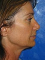 Mini Face lift