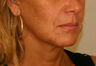 Mini Facelift (Mini lift)