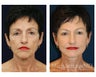 Facial Rejuvenation