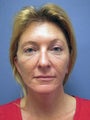Facelift