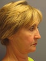 Lite Lift™, Eyelid lift, brow lift, Liposuction to chin