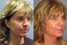 Lite Lift, Brow Lift, Neck Lift, Eyelid Lift, Blue Peel