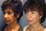 Lite Lift, Brow Lift
