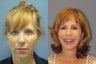 Lite Lift, Chin augmentation, liposuction of the neck