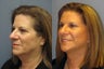 Lite Lift, brow lift, blue peel, eyelid lift