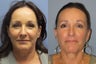 Lite Lift, Liposuction of the  neck