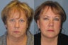 Lite Lift, liposuction of the neck, eyelid lift, brow lift