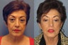 Lite Lift, neck lift, eyelid lift