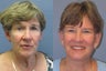 Lite lift, Neck Lift, Brow Lift