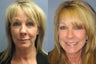 Lite Lift, Liposuction of the neck, blue peel, brow lift