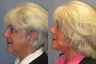 Lite Lift, Liposuction of the neck, Brow Lift, Blue Peel