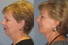 Lite Lift™, liposuction of the neck, lower eyelid lift