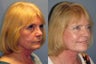 Lite Lift™, liposuction of the neck