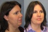 Lite Lift™, liposuction of the neck