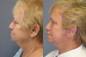 Lite Lift™, liposuction of the neck, brow lift, eyelid lift