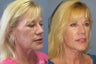 Lite Lift™, neck lift
