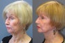 Lite Lift™, liposuction of the neck